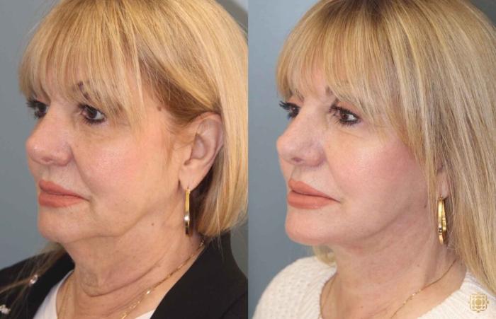 Before & After Face & Neck Lift Case 99 Left Oblique View in Newport Beach, CA