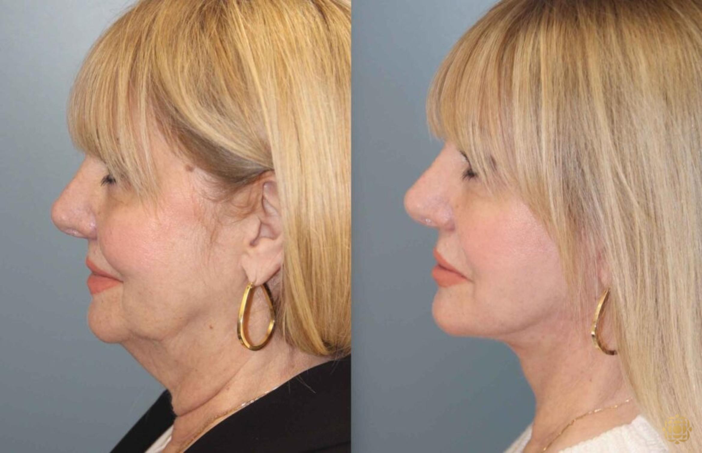 Before & After Face & Neck Lift Case 99 Left Side View in Newport Beach, CA
