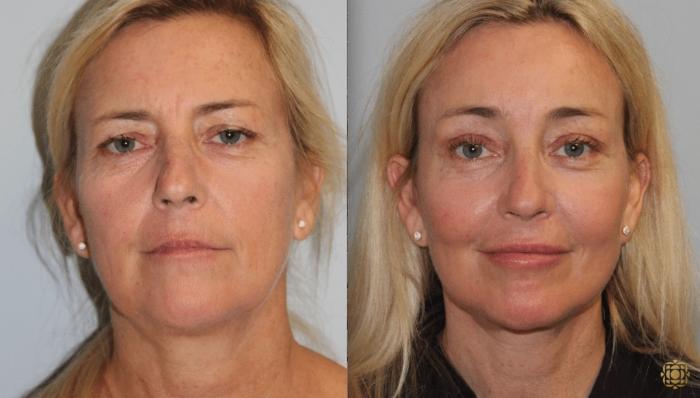 Before & After Facial Fat Grafting Case 265 Front View in Newport Beach, CA