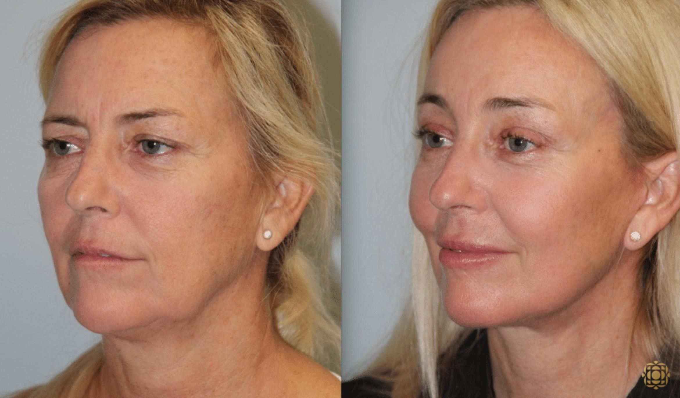 Before & After Facial Fat Grafting Case 265 Left Oblique View in Newport Beach, CA