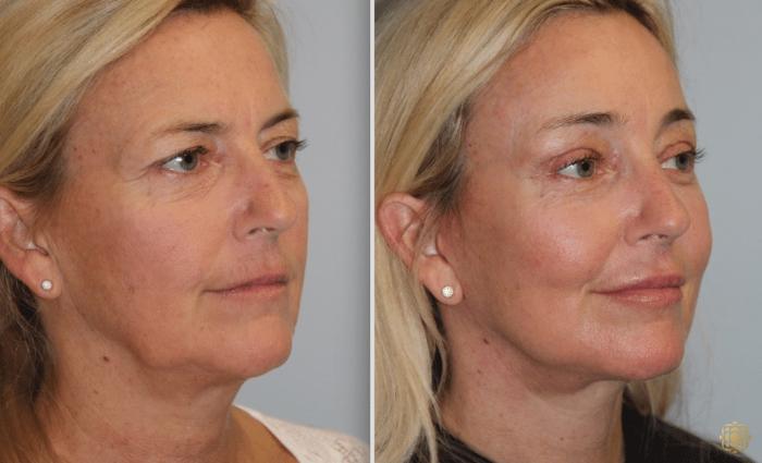Before & After Facial Fat Grafting Case 265 Right Oblique View in Newport Beach, CA
