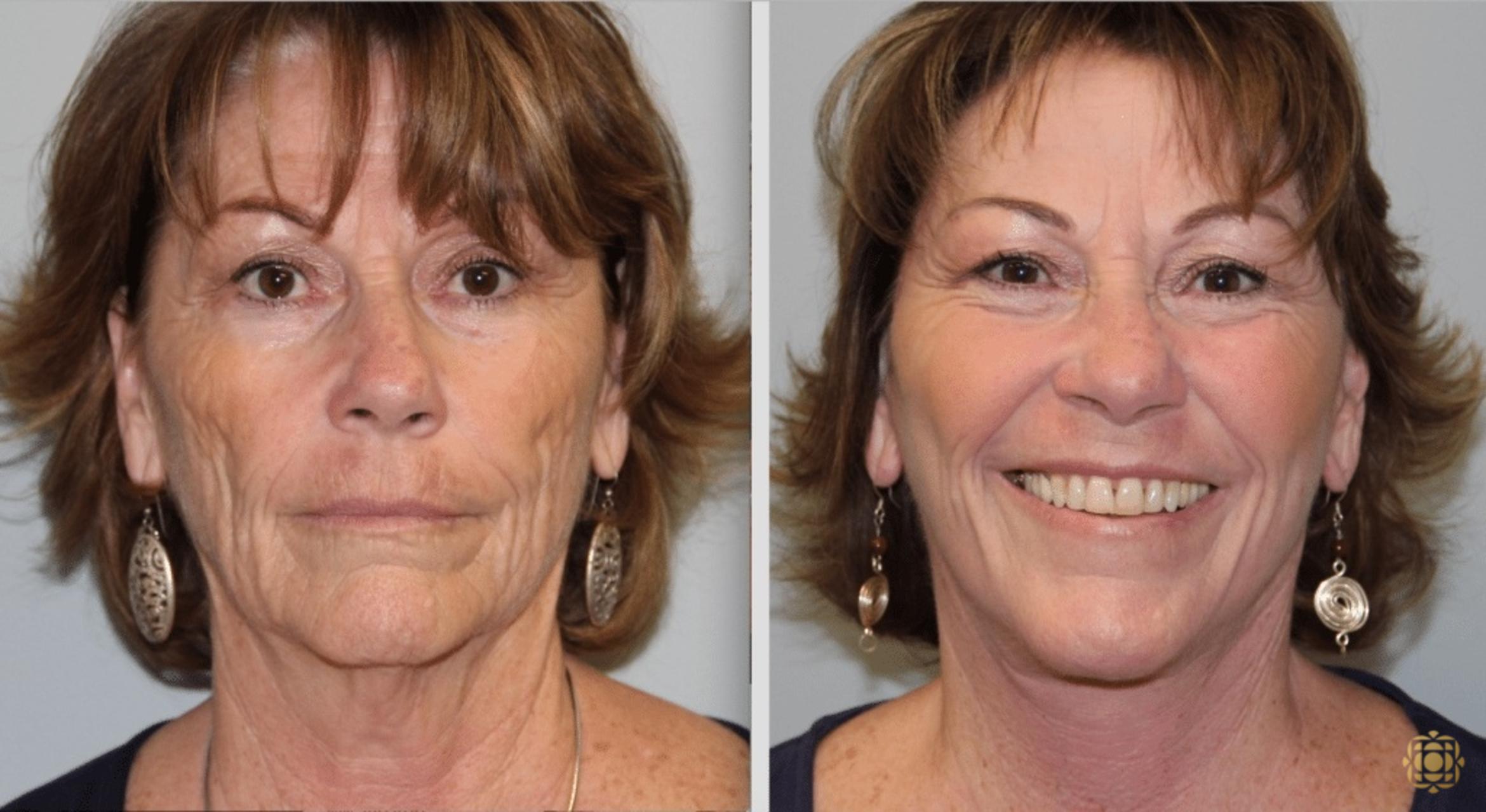 Before & After Facial Fat Grafting Case 267 Front View in Newport Beach, CA