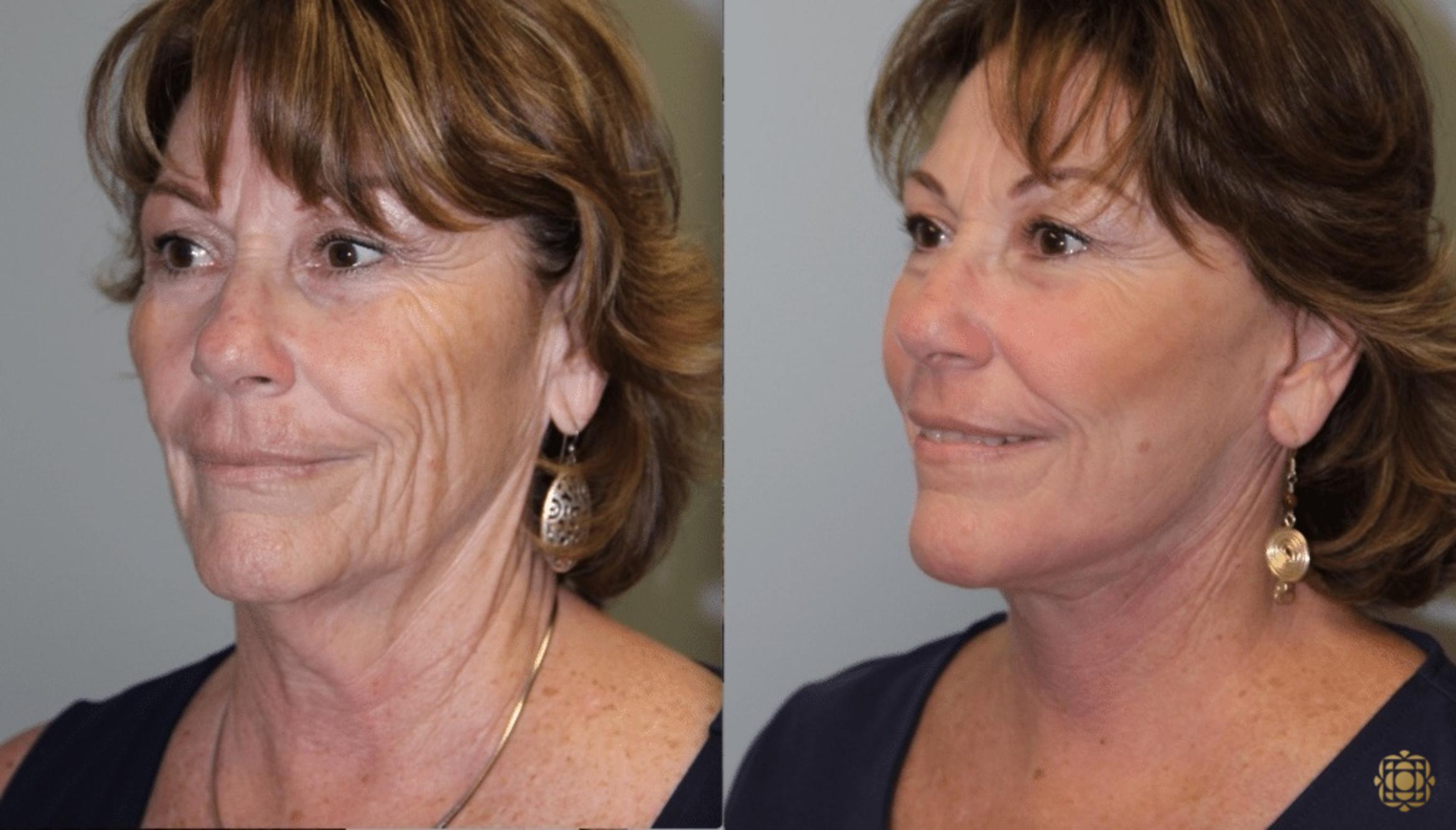 Before & After Facial Fat Grafting Case 267 Left Oblique View in Newport Beach, CA