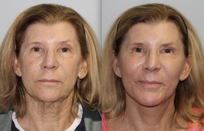 Before & After Facial Fat Grafting Case 270 Front View in Newport Beach, CA