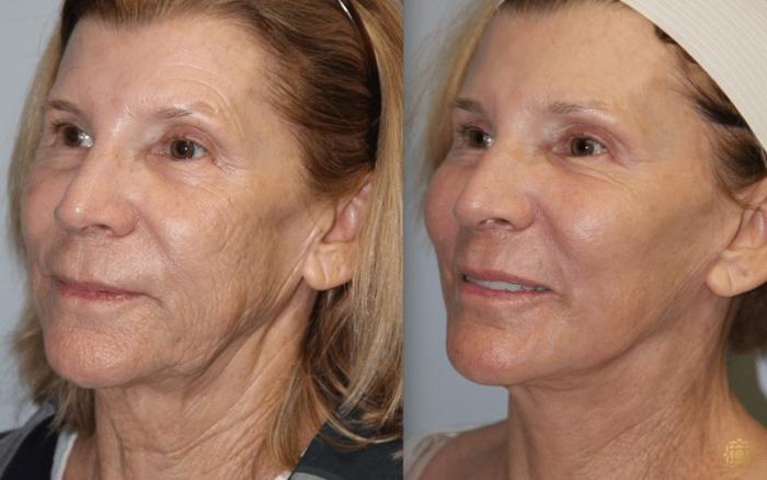 Before & After Facial Fat Grafting Case 270 Right Oblique View in Newport Beach, CA