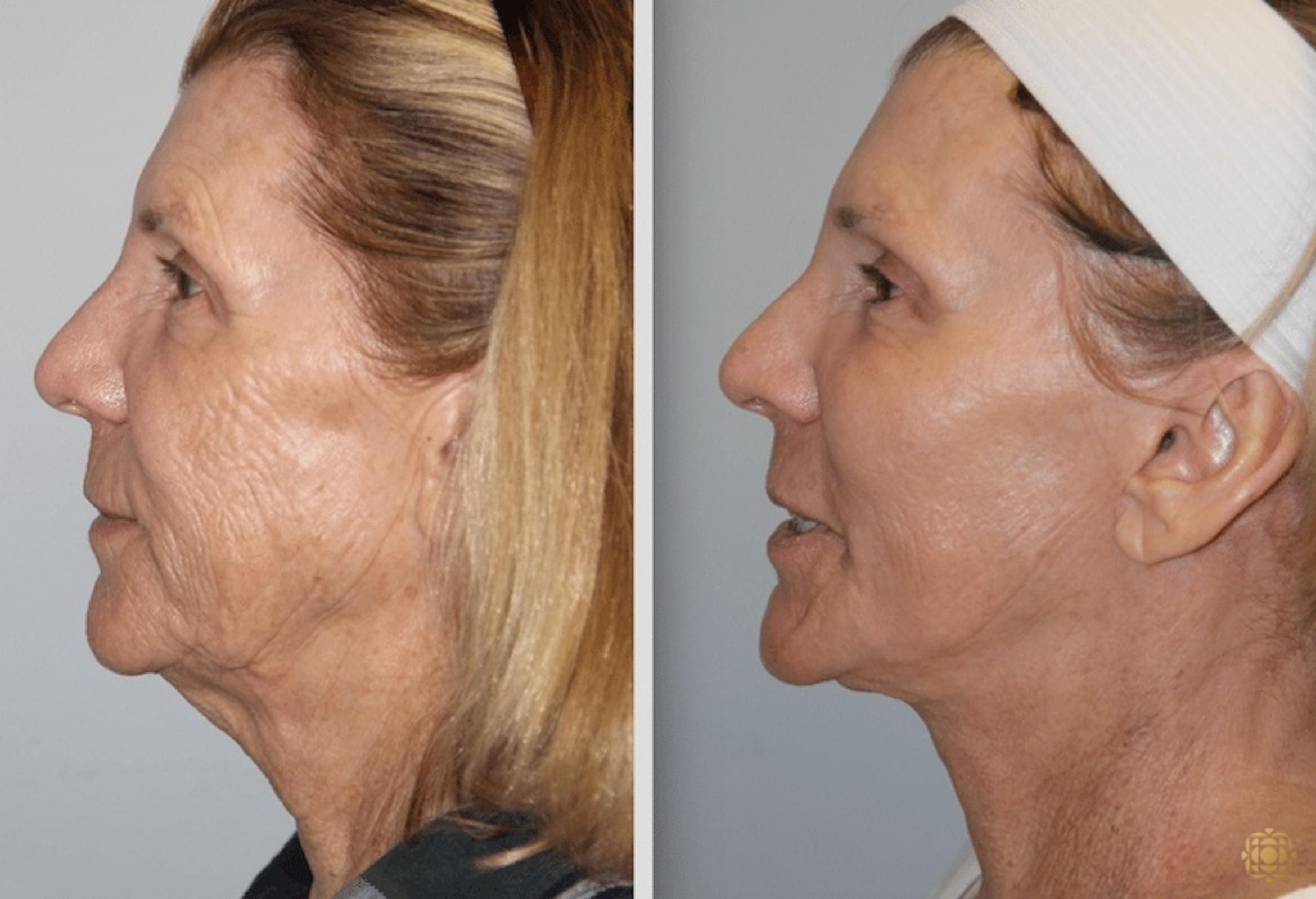Before & After Facial Fat Grafting Case 270 Right Side View in Newport Beach, CA