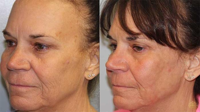 Before & After Fractional CO2 Laser Skin Resurfacing Case 320 Right Oblique View in Newport Beach, CA