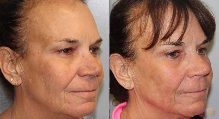 Before & After Fractional CO2 Laser Skin Resurfacing Case 320 View #1 View in Newport Beach, CA