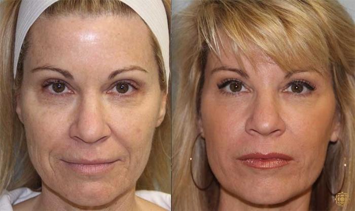 Before & After Fractional CO2 Laser Skin Resurfacing Case 323 Front View in Newport Beach, CA