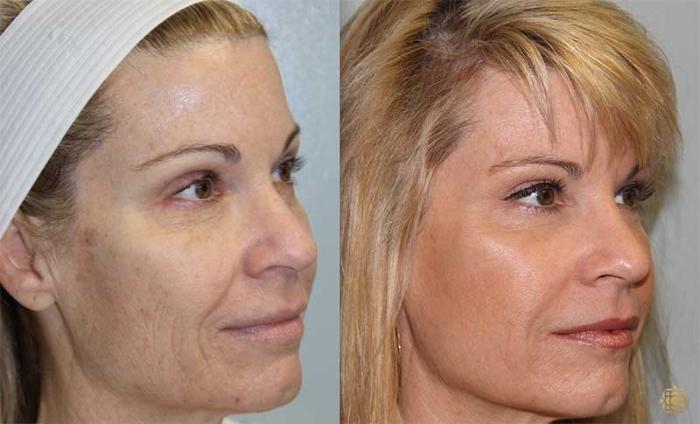 Before & After Fractional CO2 Laser Skin Resurfacing Case 323 Left Oblique View in Newport Beach, CA