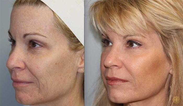 Before & After Fractional CO2 Laser Skin Resurfacing Case 323 Right Oblique View in Newport Beach, CA