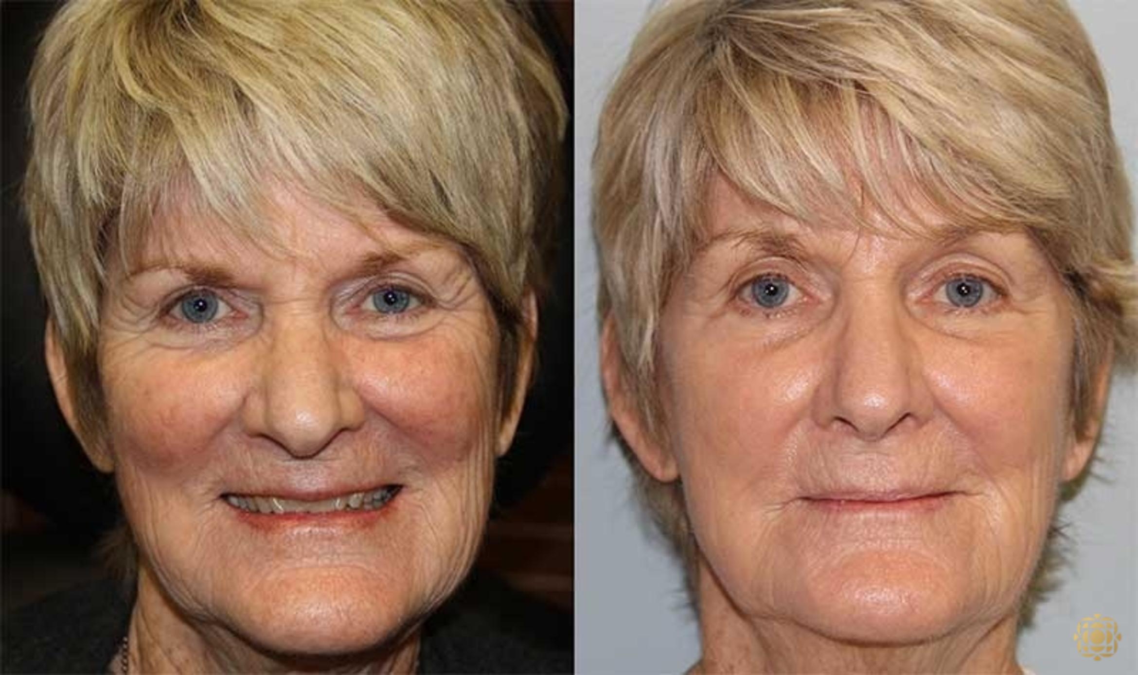 Before & After Fractional CO2 Laser Skin Resurfacing Case 325 Front View in Newport Beach, CA