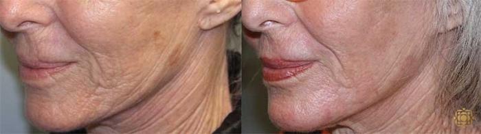 Before & After Fractional CO2 Laser Skin Resurfacing Case 325 Left Oblique 2 View in Newport Beach, CA
