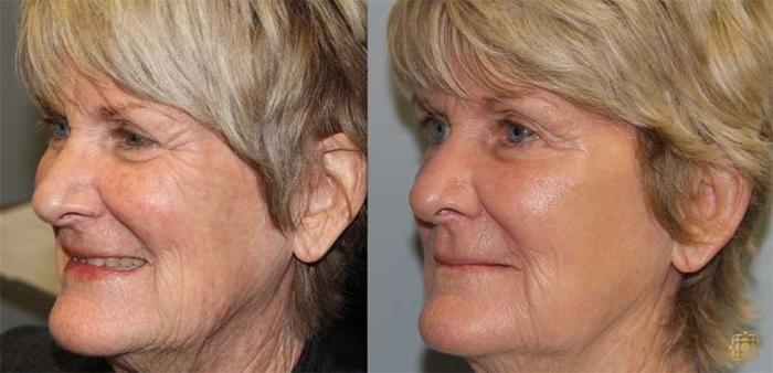 Before & After Fractional CO2 Laser Skin Resurfacing Case 325 Left Oblique View in Newport Beach, CA