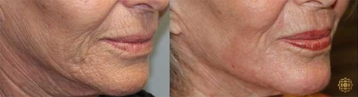 Before & After Fractional CO2 Laser Skin Resurfacing Case 325 Right Oblique 2 View in Newport Beach, CA