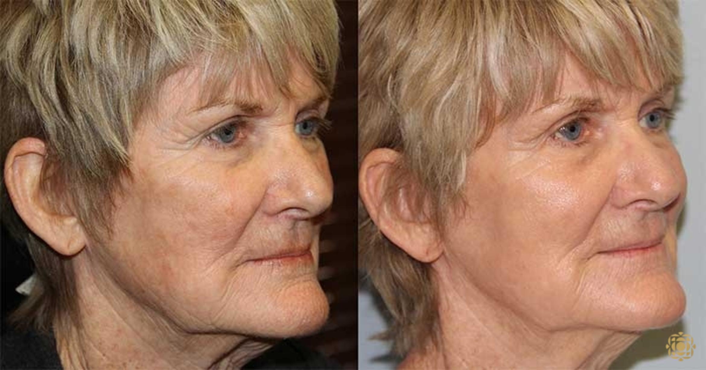 Before & After Fractional CO2 Laser Skin Resurfacing Case 325 Right Oblique View in Newport Beach, CA