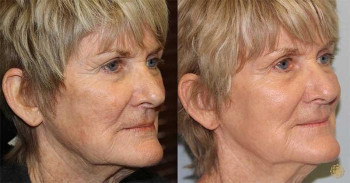 Before & After Fractional CO2 Laser Skin Resurfacing Case 325 Right Oblique View in Newport Beach, CA