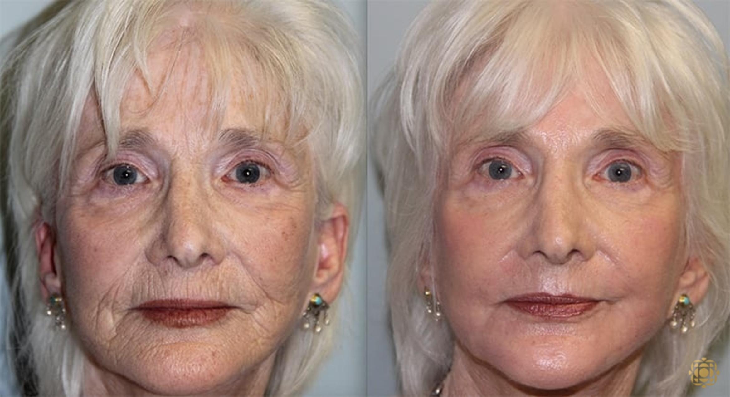 Before & After Fractional CO2 Laser Skin Resurfacing Case 327 Front View in Newport Beach, CA