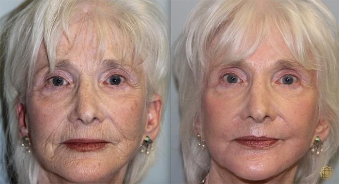 Before & After Fractional CO2 Laser Skin Resurfacing Case 327 Front View in Newport Beach, CA