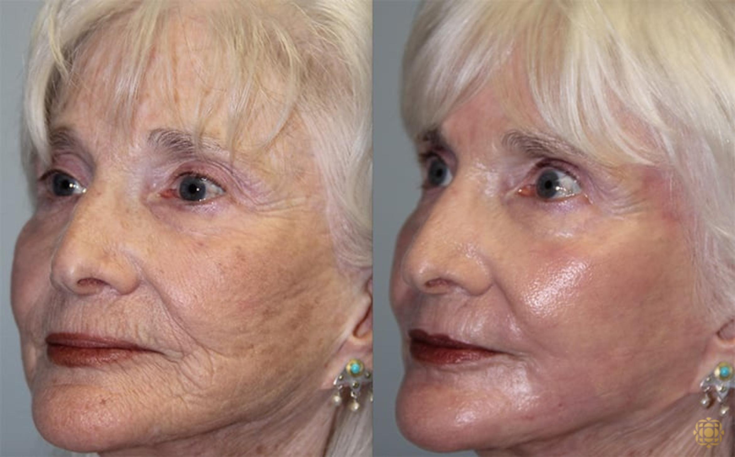 Before & After Fractional CO2 Laser Skin Resurfacing Case 327 Left Oblique View in Newport Beach, CA