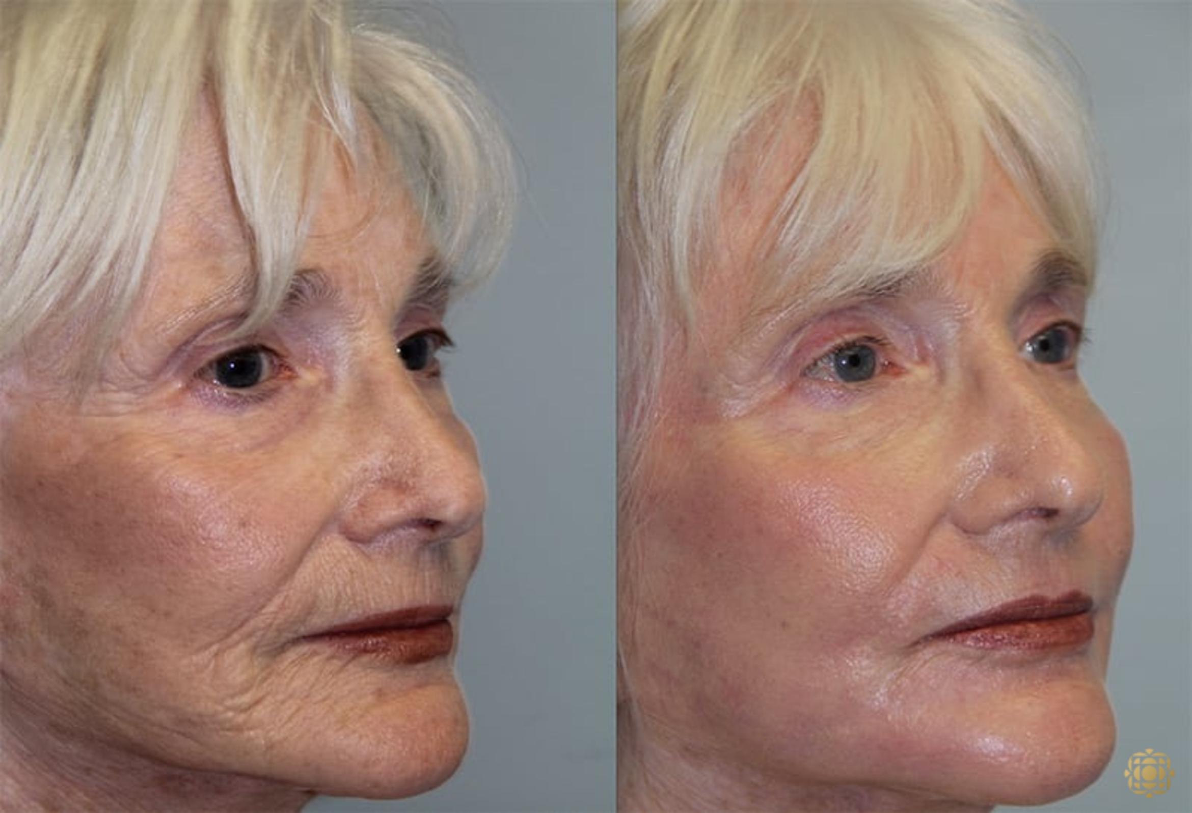 Before & After Fractional CO2 Laser Skin Resurfacing Case 327 Right Oblique View in Newport Beach, CA