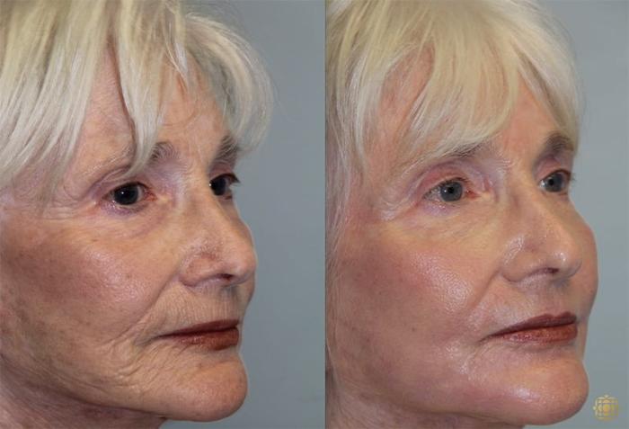 Before & After Fractional CO2 Laser Skin Resurfacing Case 327 Right Oblique View in Newport Beach, CA