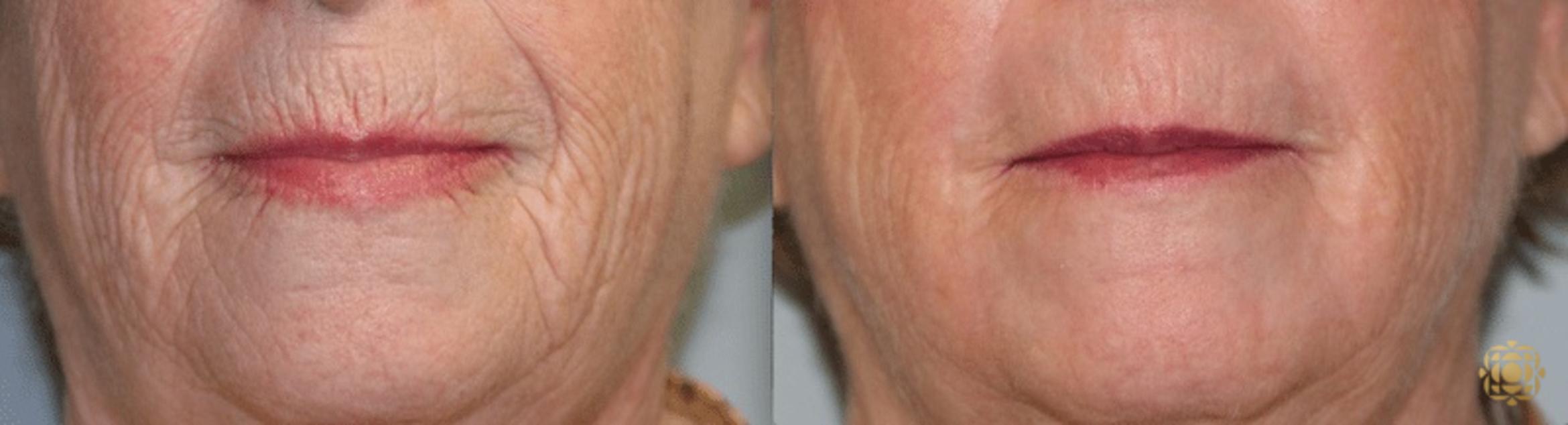 Before & After Fractional CO2 Laser Skin Resurfacing Case 328 View #1 View in Newport Beach, CA