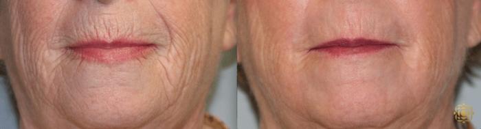 Before & After Fractional CO2 Laser Skin Resurfacing Case 328 View #1 View in Newport Beach, CA