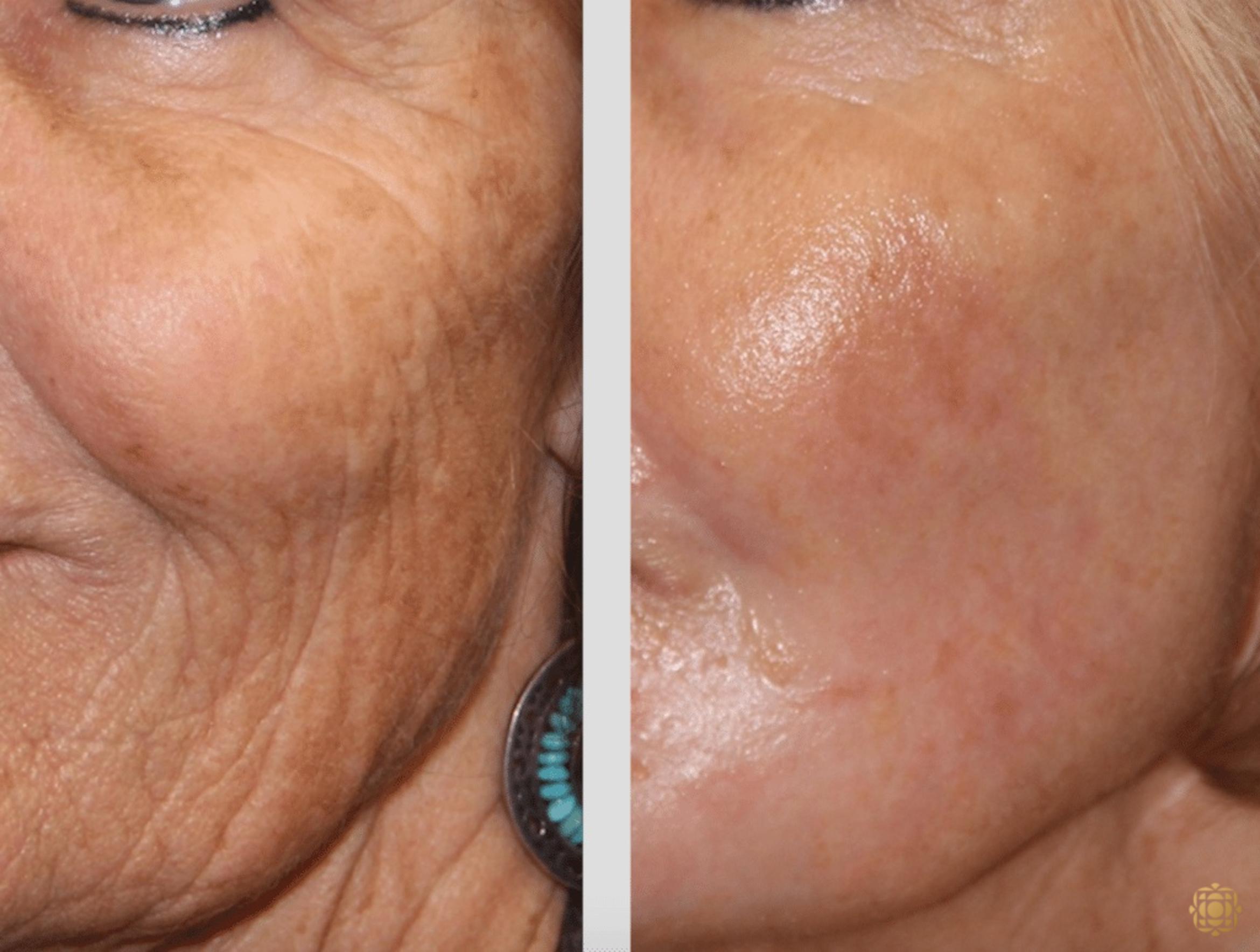 Before & After Fractional CO2 Laser Skin Resurfacing Case 333 View #1 View in Newport Beach, CA