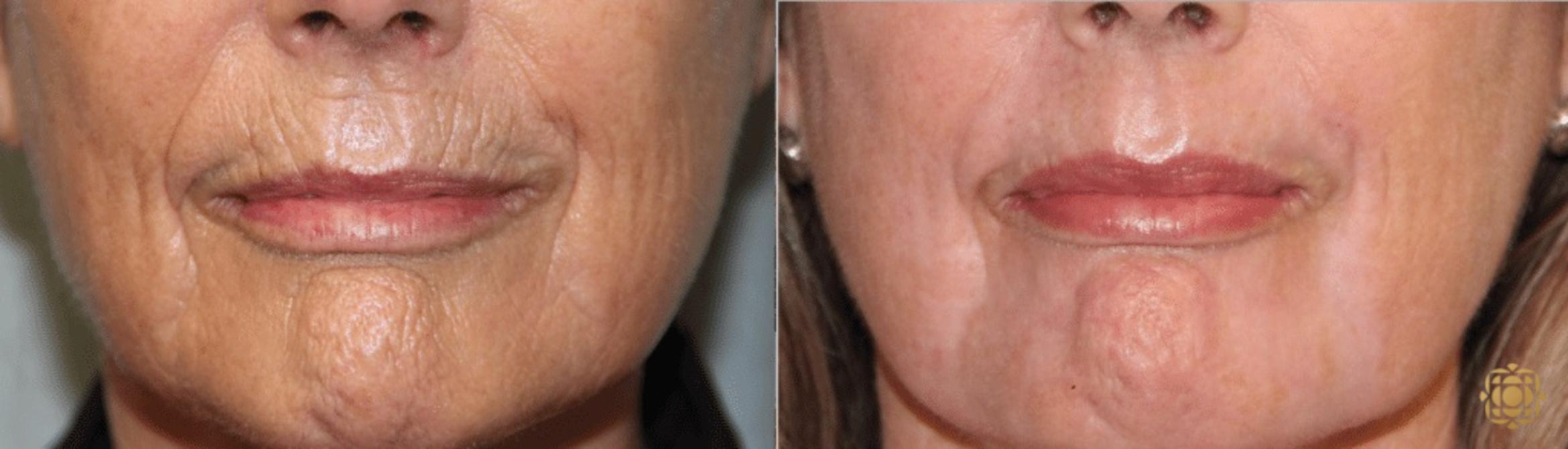 Before & After Fractional CO2 Laser Skin Resurfacing Case 334 View #1 View in Newport Beach, CA