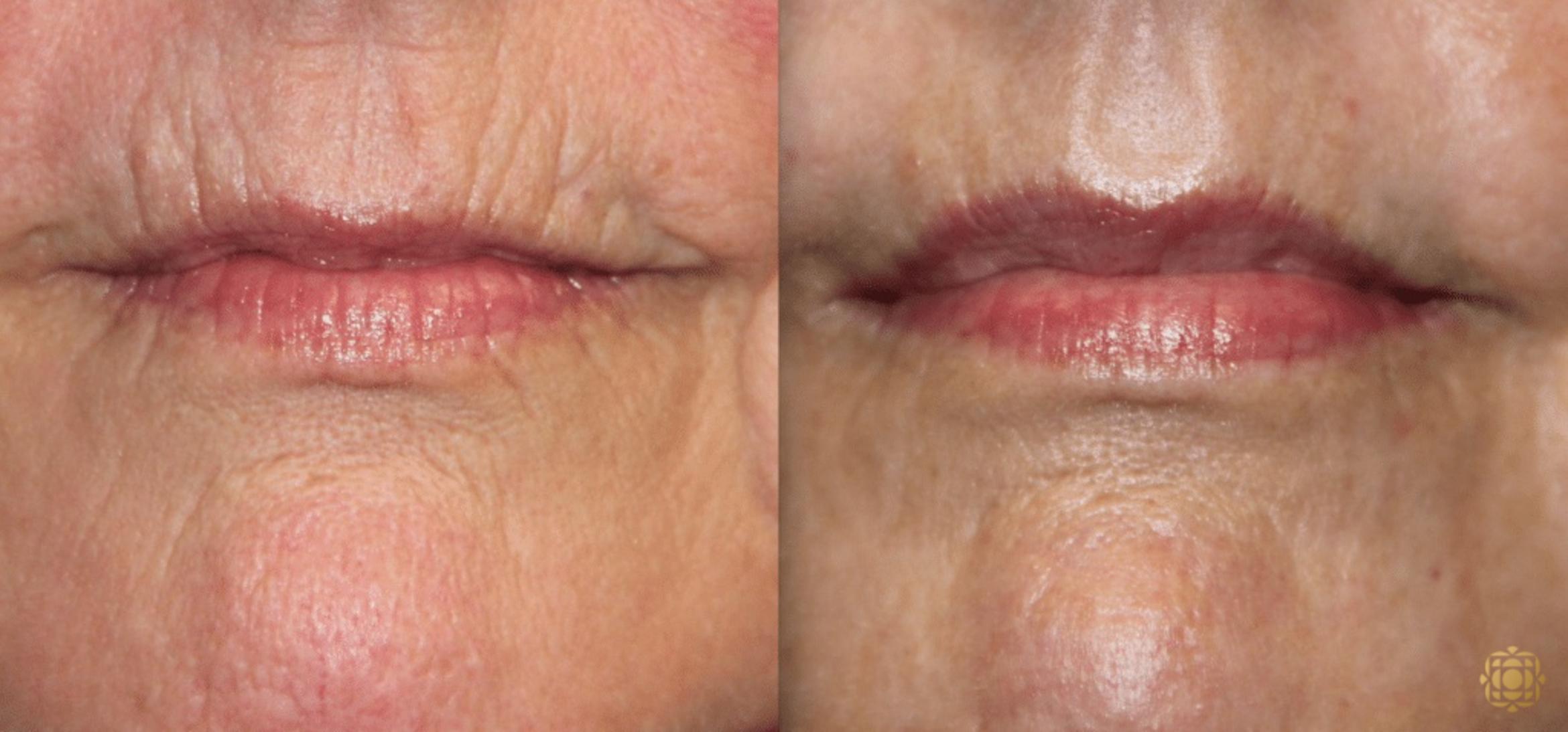 Before & After Fractional CO2 Laser Skin Resurfacing Case 335 View #1 View in Newport Beach, CA