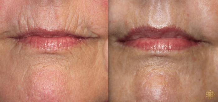 Before & After Fractional CO2 Laser Skin Resurfacing Case 335 View #1 View in Newport Beach, CA