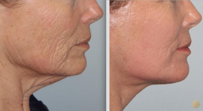 Before & After Fractional CO2 Laser Skin Resurfacing Case 336 View #1 View in Newport Beach, CA