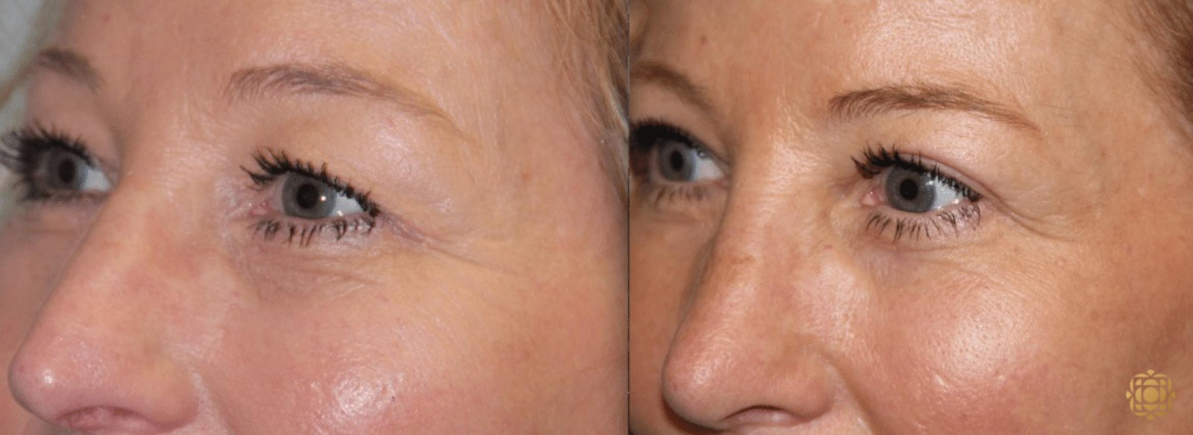 Before & After Fractional CO2 Laser Skin Resurfacing Case 337 View #2 View in Newport Beach, CA