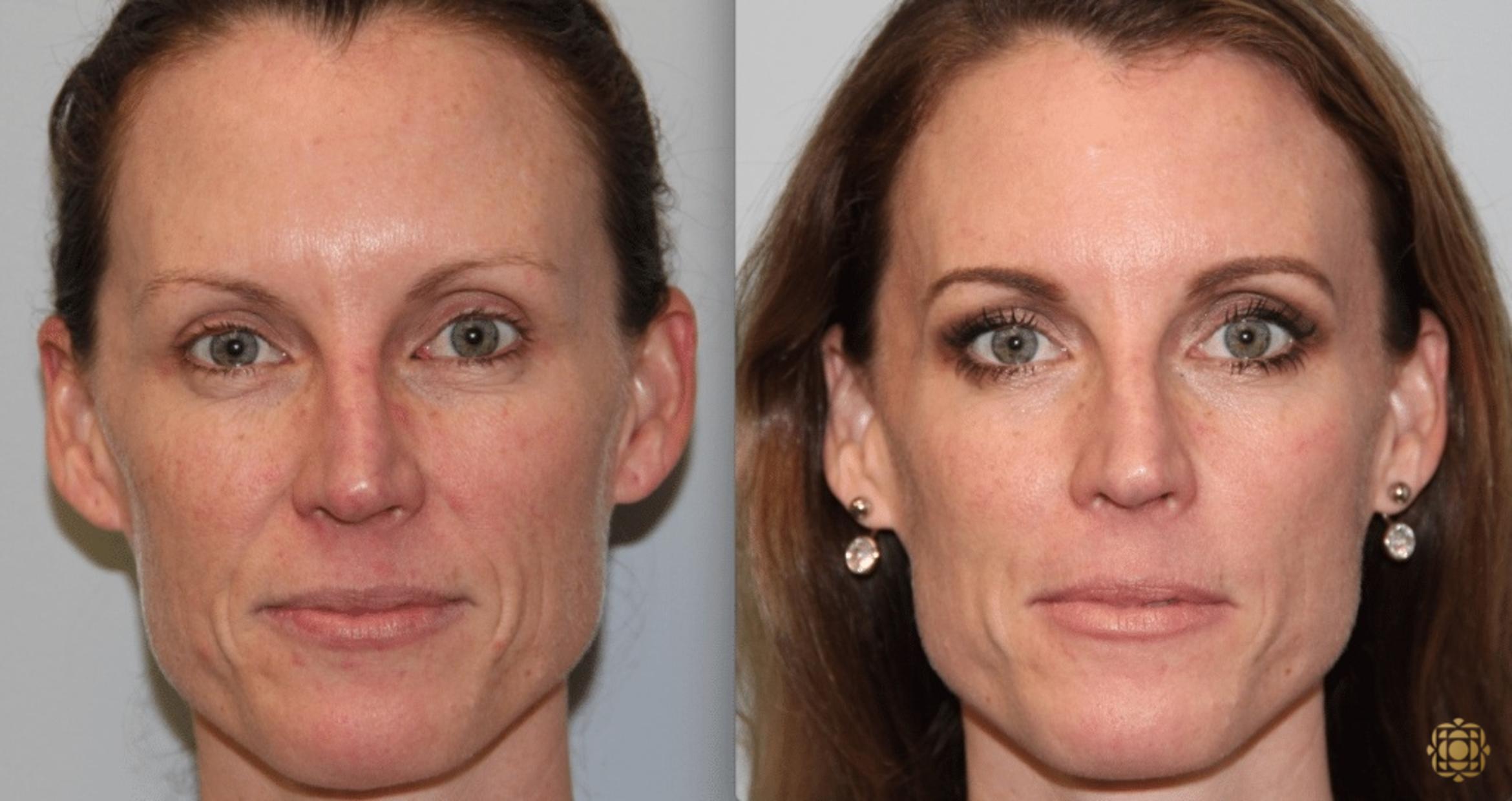 Before & After Fractional CO2 Laser Skin Resurfacing Case 338 Front View in Newport Beach, CA