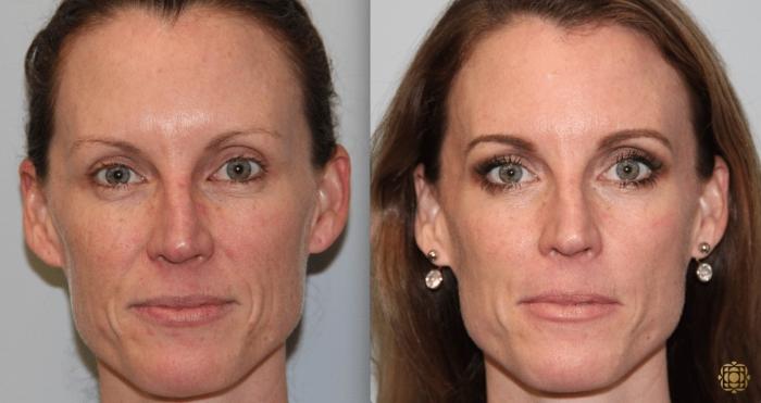 Before & After Fractional CO2 Laser Skin Resurfacing Case 338 Front View in Newport Beach, CA