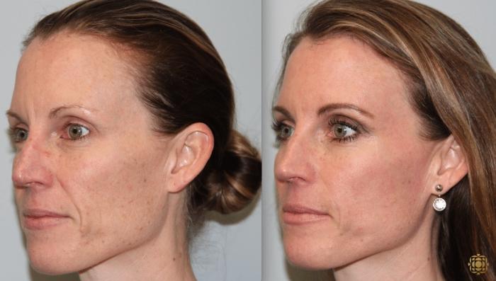 Before & After Fractional CO2 Laser Skin Resurfacing Case 338 Left Oblique View in Newport Beach, CA
