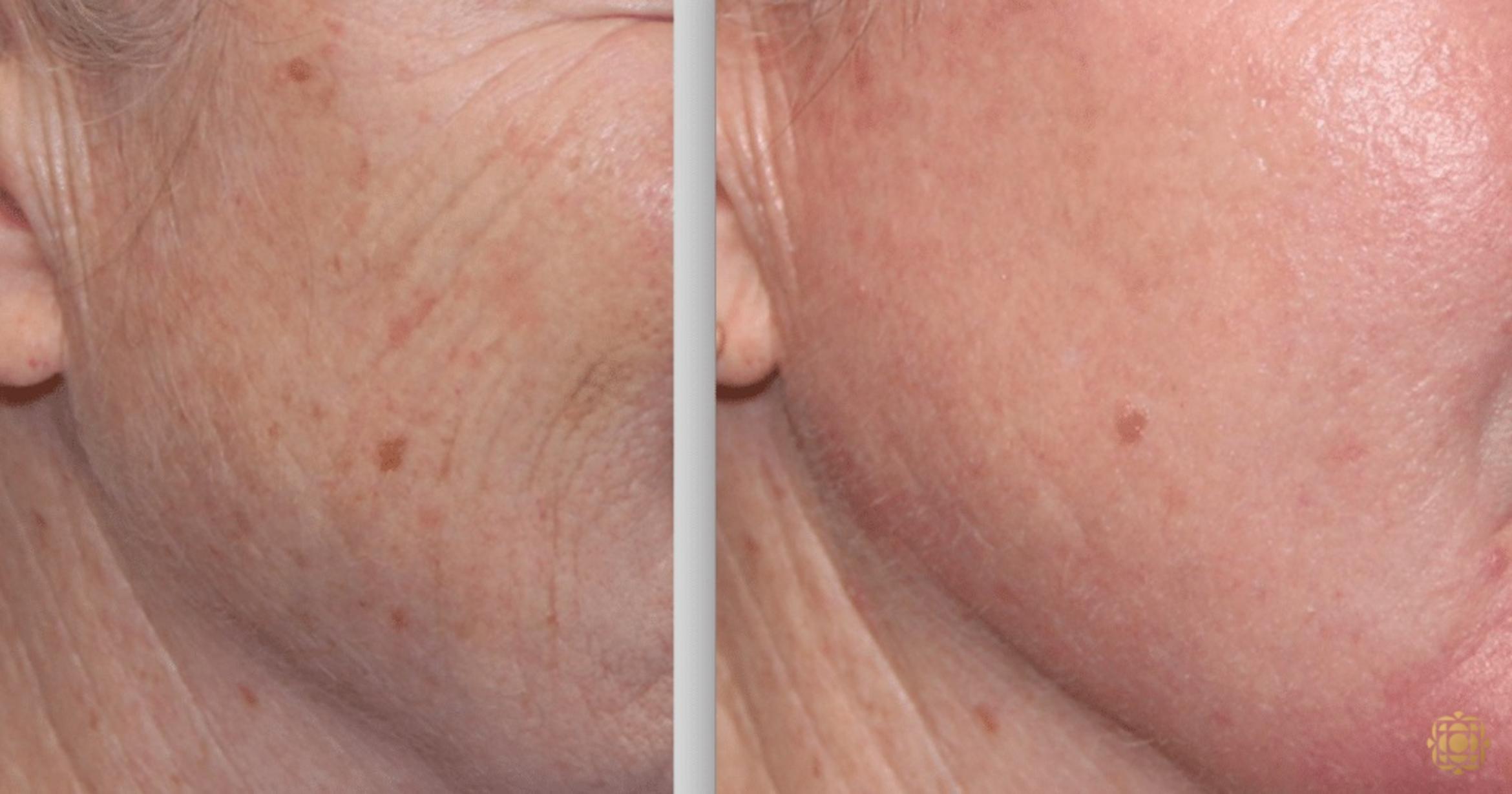 Before & After Fractional CO2 Laser Skin Resurfacing Case 341 View #1 View in Newport Beach, CA