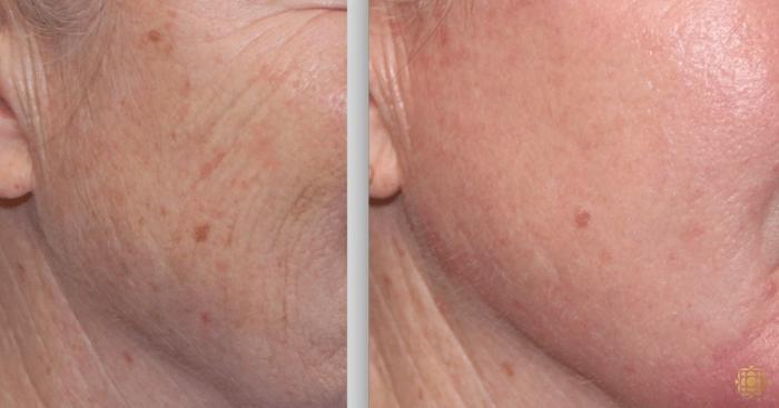 Before & After Fractional CO2 Laser Skin Resurfacing Case 341 View #1 View in Newport Beach, CA