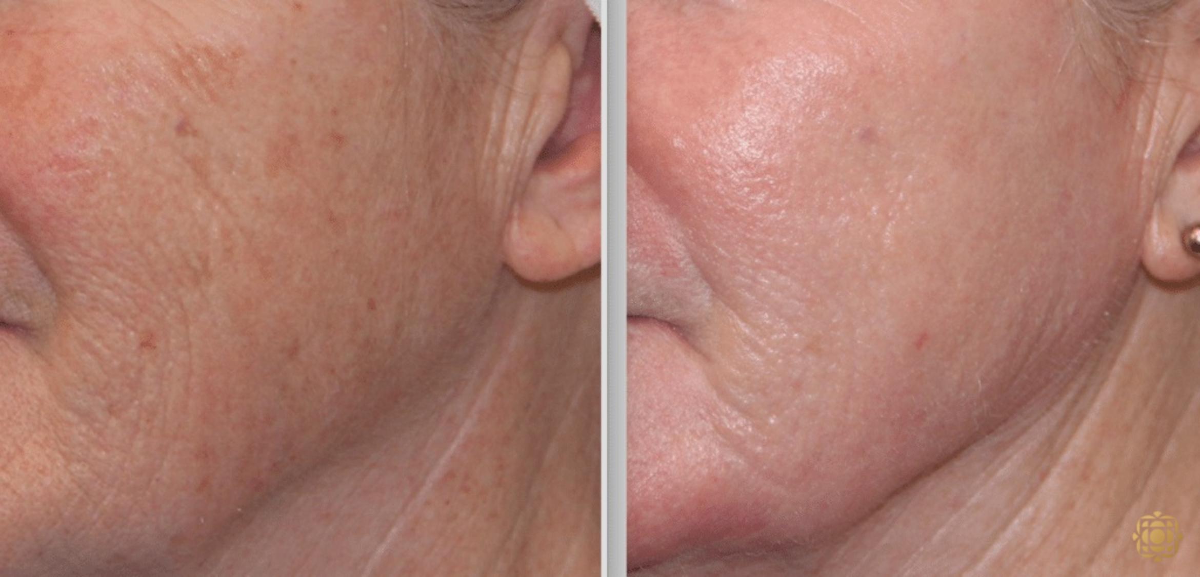 Before & After Fractional CO2 Laser Skin Resurfacing Case 341 View #2 View in Newport Beach, CA