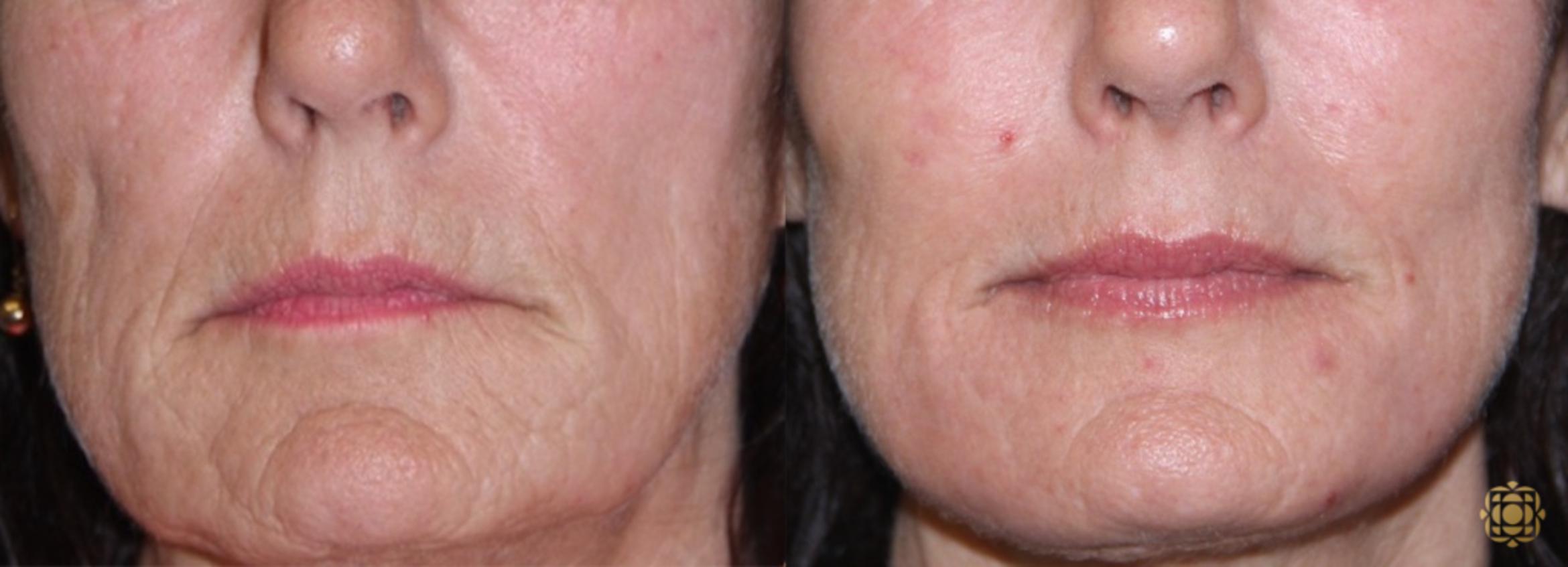 Before & After Fractional CO2 Laser Skin Resurfacing Case 342 View #1 View in Newport Beach, CA