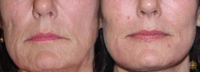 Before & After Fractional CO2 Laser Skin Resurfacing Case 342 View #1 View in Newport Beach, CA