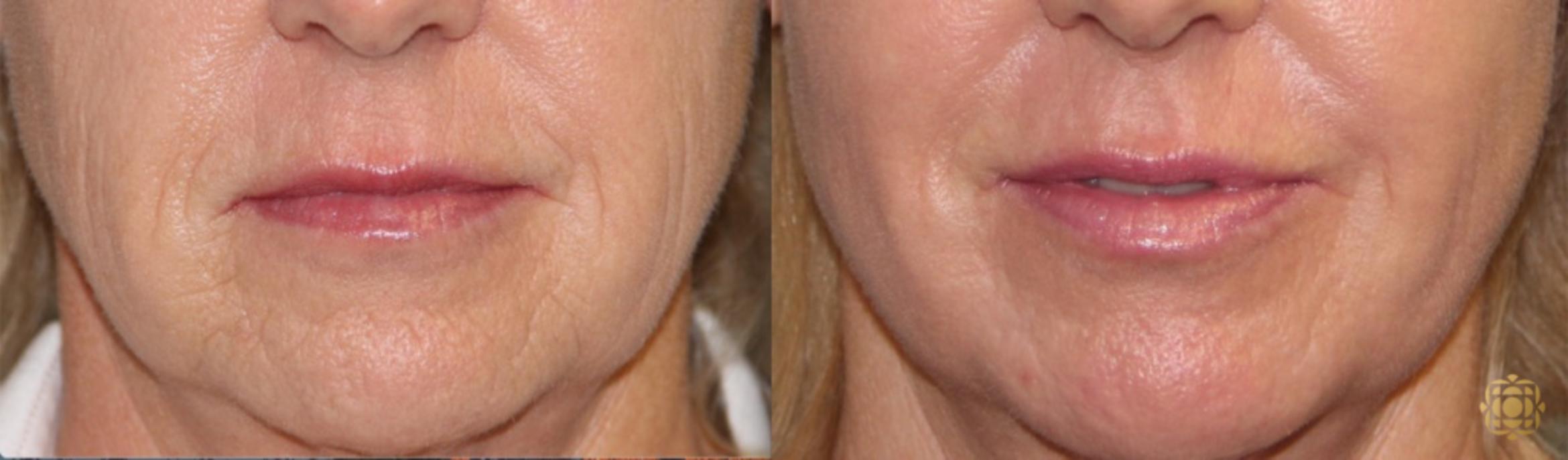 Before & After Fractional CO2 Laser Skin Resurfacing Case 343 View #1 View in Newport Beach, CA