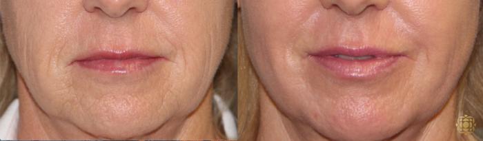 Before & After Fractional CO2 Laser Skin Resurfacing Case 343 View #1 View in Newport Beach, CA