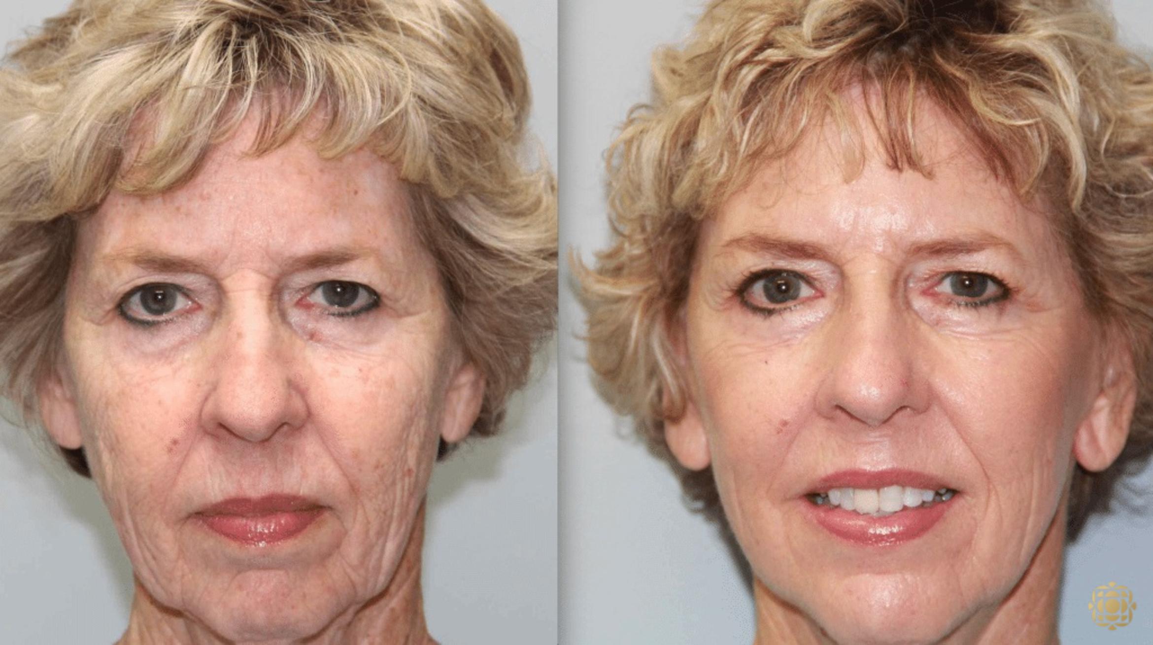 Before & After Fractional CO2 Laser Skin Resurfacing Case 345 View #1 View in Newport Beach, CA