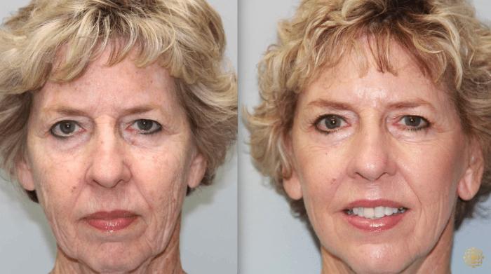 Before & After Fractional CO2 Laser Skin Resurfacing Case 345 View #1 View in Newport Beach, CA
