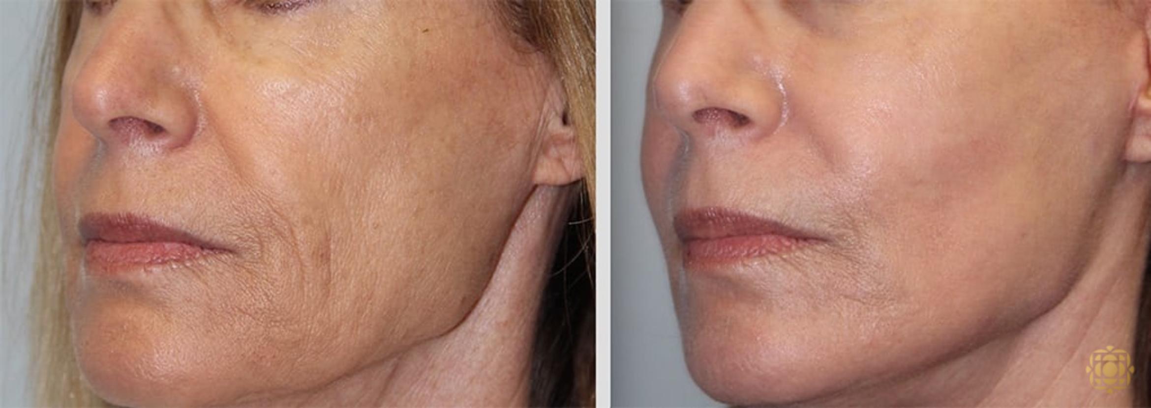 Before & After Fractional CO2 Laser Skin Resurfacing Case 346 View #1 View in Newport Beach, CA