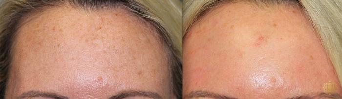 Before & After Fractional CO2 Laser Skin Resurfacing Case 347 View #1 View in Newport Beach, CA