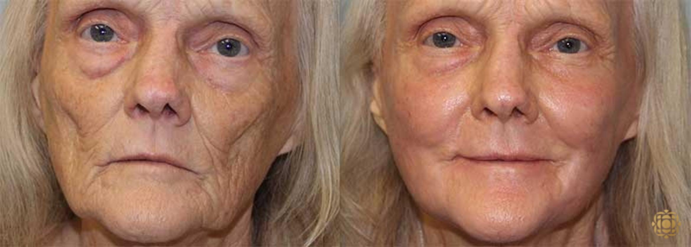 Before & After Fractional CO2 Laser Skin Resurfacing Case 349 View #1 View in Newport Beach, CA