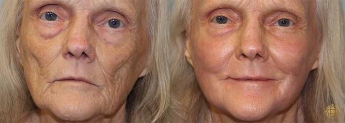 Before & After Fractional CO2 Laser Skin Resurfacing Case 349 View #1 View in Newport Beach, CA